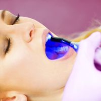 Las mejores técnicas de blanqueamiento dental