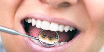 7 Respuestas sobre ortodoncia lingual