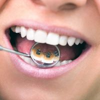 7 Respuestas sobre ortodoncia lingual