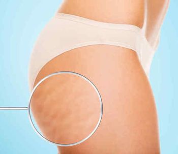 6 consejos para acabar con la celulitis