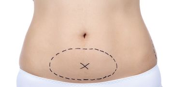 Tummy Tuck: La mini abdominoplastia