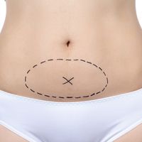 Tummy Tuck: La mini abdominoplastia