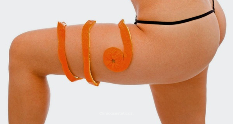 Vacumterapia, la solución a la piel naranja