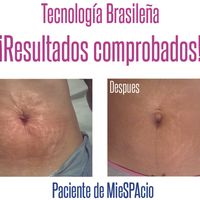 Tratamiento de estrias