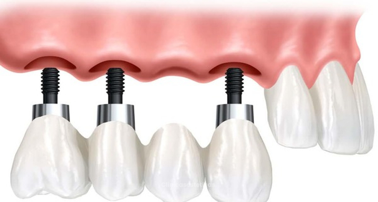 ¿Puente o implante dental?