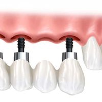 ¿Puente o implante dental?