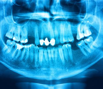 Los materiales a usar a la hora de una reconstrucción dental