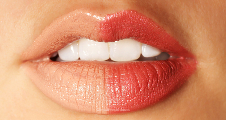 ​Permalip: labios con volumen permanente