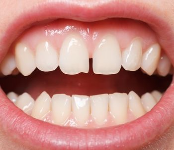Dientes separados: alternativas para corregirlos