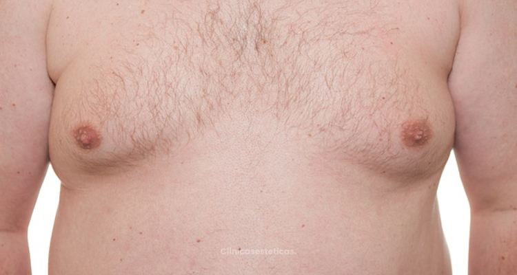 Ginecomastia: la solución al exceso de pecho masculino