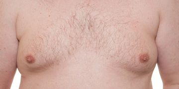 Ginecomastia: la solución al exceso de pecho masculino