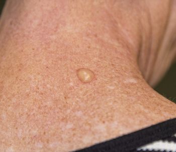 ¿Cómo distinguir las verrugas de la queratosis seborreica?