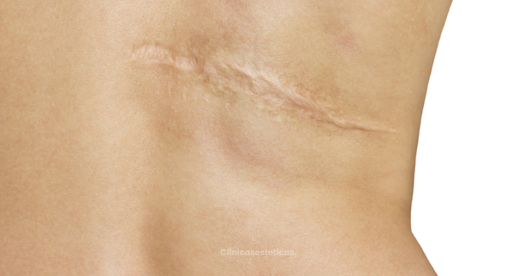 ​Células madres o plasma: dos exitosos tratamientos para tratar las cicatrices