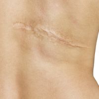 ​Células madres o plasma: dos exitosos tratamientos para tratar las cicatrices