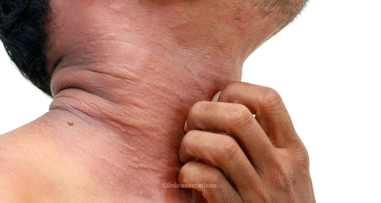 ​Dermatitis: causas, síntomas y tratamientos