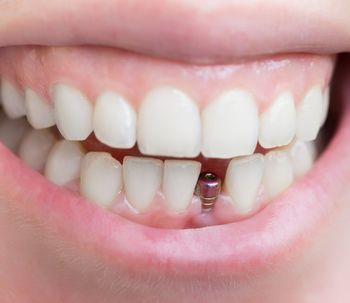 Consigue una sonrisa sana y linda con los implantes dentales de carga inmediata