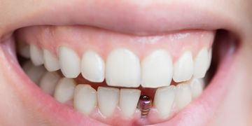 ​Consigue una sonrisa sana y linda con los implantes dentales de carga inmediata