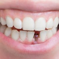 ​Consigue una sonrisa sana y linda con los implantes dentales de carga inmediata