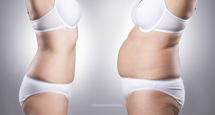 ​Los seis tipos de abdominoplastía: ¿cuál será la tuya?