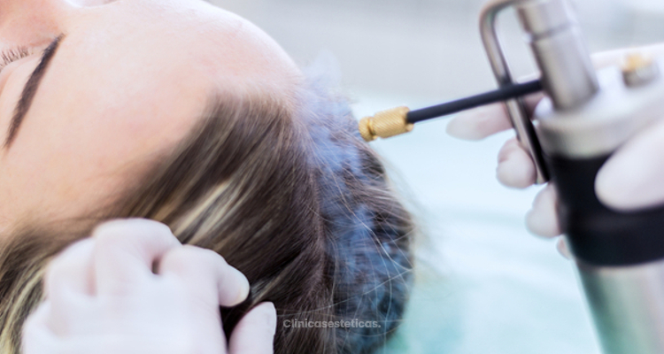 La crioterapia, una forma de detener la alopecia durante el proceso de quimio