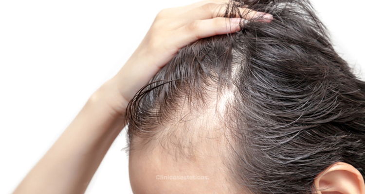 ​Causas y tratamientos para controlar la alopecia