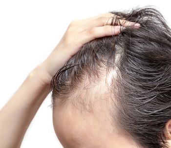 Causas y tratamientos para controlar la alopecia