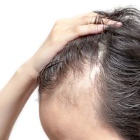 ​Causas y tratamientos para controlar la alopecia
