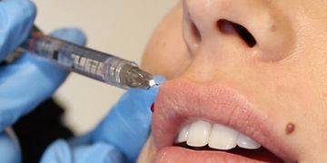 Aumenta tus labios sin cirugía con estos procedimientos