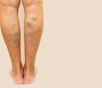 Varices: su origen y los tratamientos para eliminarlas