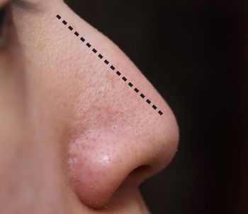 ¿Decepcionada tras malos resultados de una Rinoplastia?