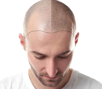 ¿Por qué se produce y como tratar la alopecia?