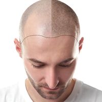 ¿Por qué se produce y cómo tratar la alopecia?