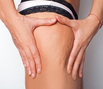 ¿Cómo acabo con la celulitis?