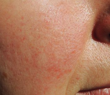 ¿Es el ácaro Demodex folliculoru un causante de la rosácea?