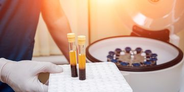 Una piel más joven sin cirugía: Plasma Rico en Plaquetas