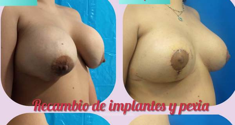 Evolución de la mamoplastía reductiva