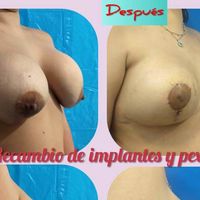 Evolución de la mamoplastía reductiva