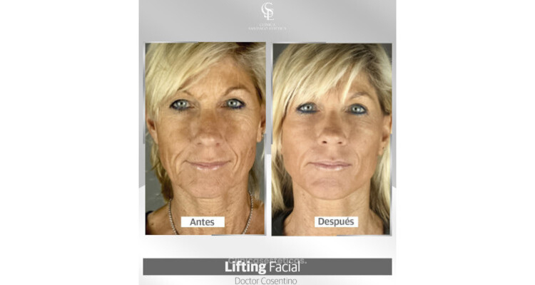Lifting facial, la cirugía que le devuelve juventud al rostro