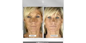 Lifting facial, la cirugía que le devuelve juventud al rostro