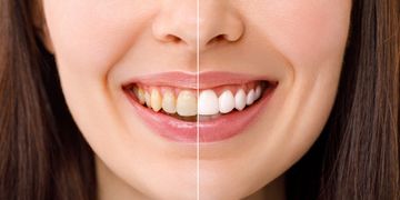 Sonríe con confianza: Descubre el poder del blanqueamiento dental