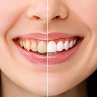 Sonríe con confianza: Descubre el poder del blanqueamiento dental