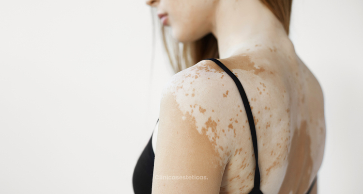 Superando el estigma del vitiligo