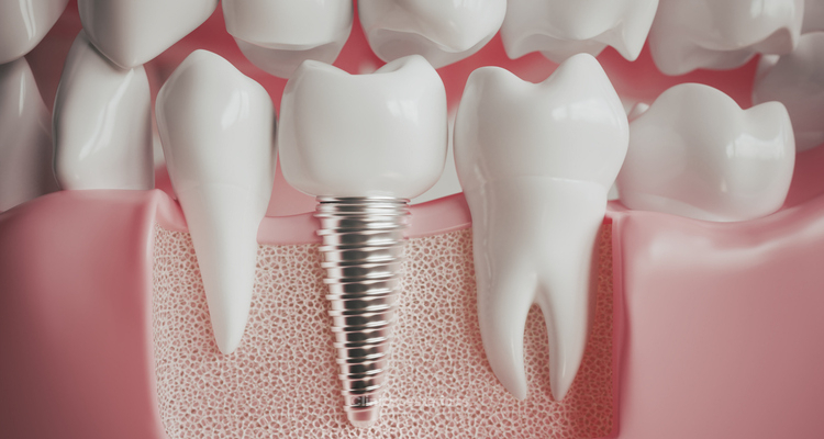 Implantes dentales: lo que debes saber antes