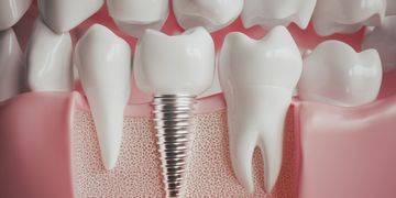 Implantes dentales: lo que debes saber antes