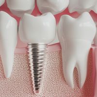 Implantes dentales: lo que debes saber antes
