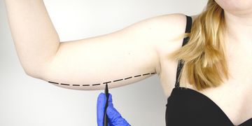 Braquioplastía: cicatrices y cuidados postoperatorios