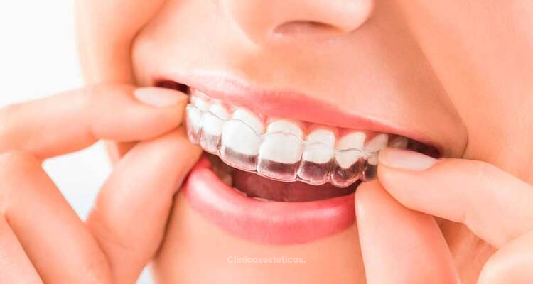 Ortodoncia Invisible: La Revolución Estética y Digital que Está Transformando las Sonrisas