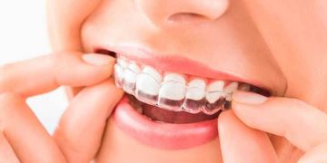 Ortodoncia Invisible: La Revolución Estética y Digital que Está Transformando las Sonrisas