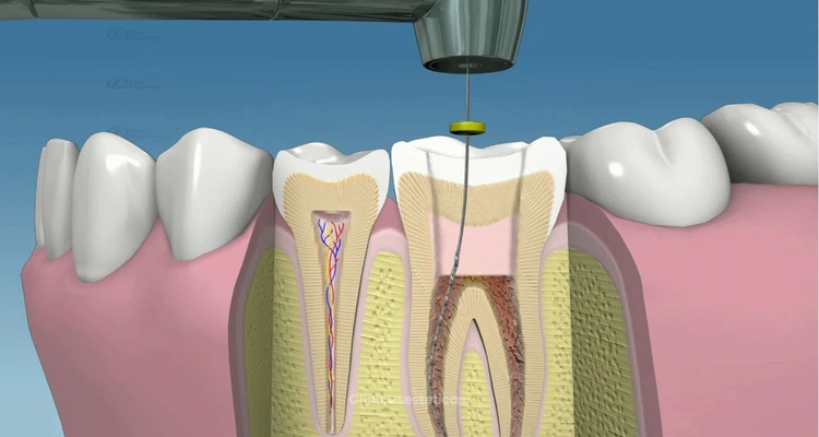 Endodoncia Mecanizada: Precisión, Eficiencia y Revolución en la Terapia de Conductos con Motor Endodóntico