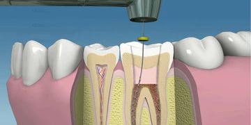 Endodoncia Mecanizada: Precisión, Eficiencia y Revolución en la Terapia de Conductos con Motor Endodóntico